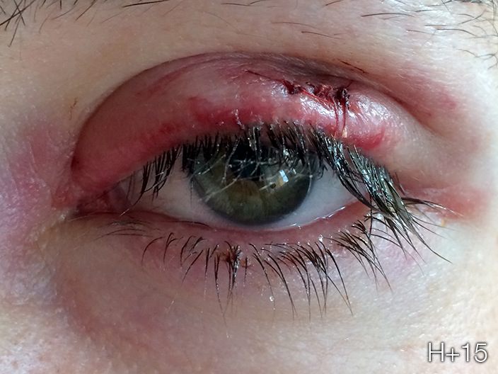 Chalazion surgery step 2